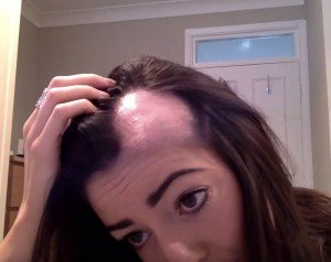 Alopecia_femenina
