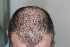man-hair-loss