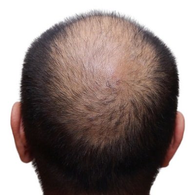 Common Hair Loss Conditions