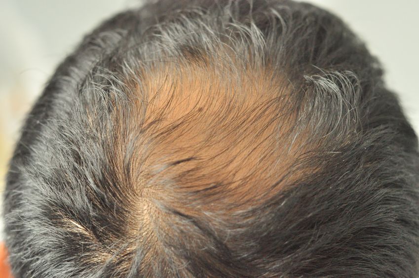 hair loss solutions at top London hair replacement salon