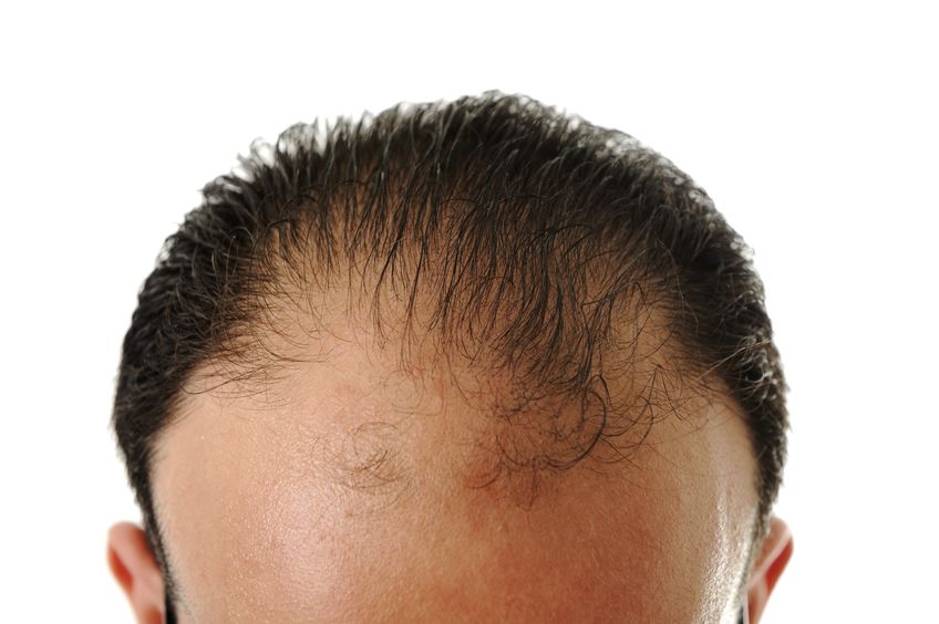 hair loss solutions for men in London