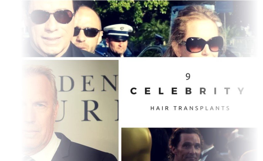 celebrity hair transplants hair replacement in London