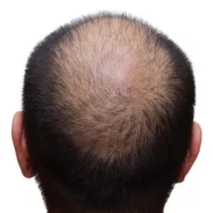 Mens hair loss treatments in London Holborn