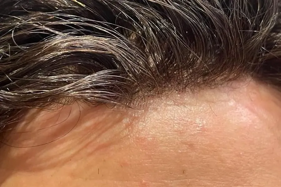 thinning hair solutions