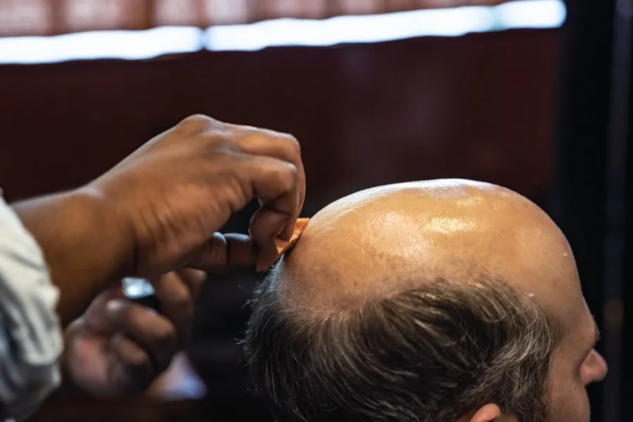 Hair Replacement