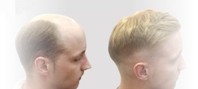 BEST-MENS-HAIR-REPLACEMENT-SYSTEMS-IN-LONDON-UK