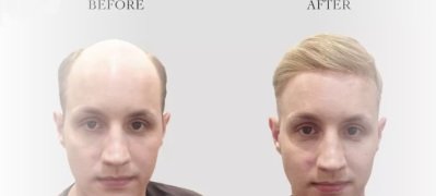 HAIR-REPLACEMENT-SYSTEMS-FOR-MEN-IN-LONDON